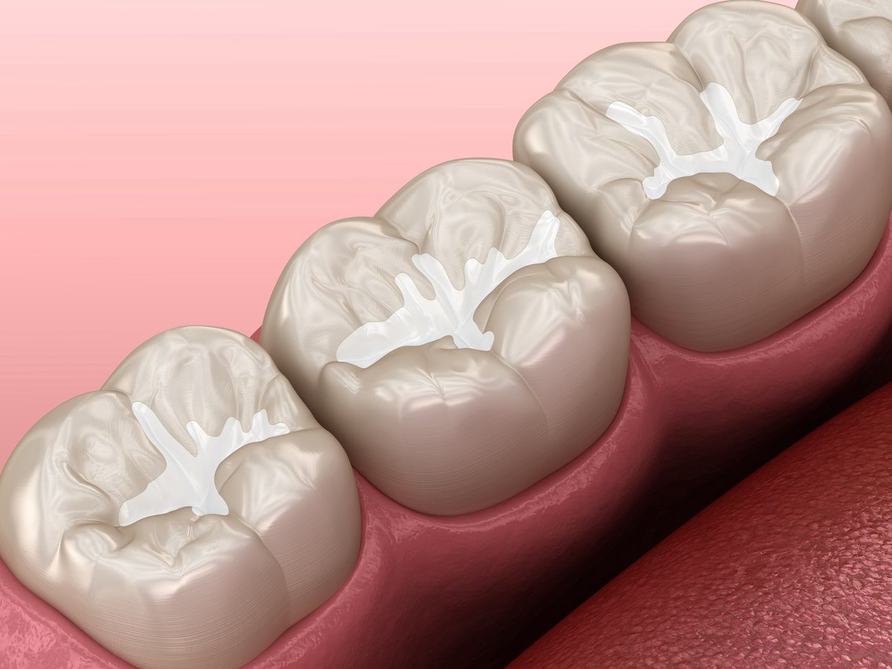 Dental-Sealants
